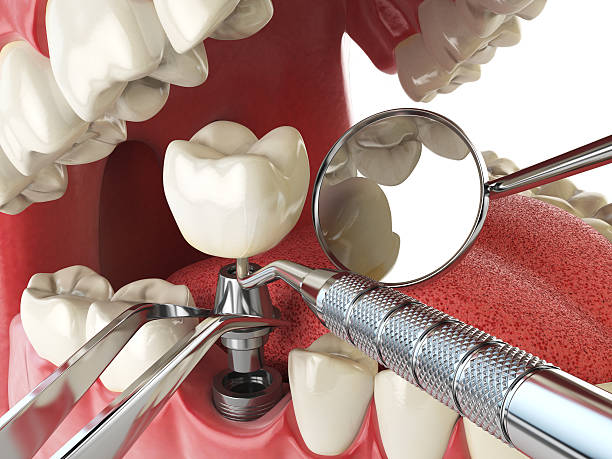 Best Emergency Root Canal Treatment in Gallitzin, PA